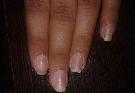 Fungal Nail Infections Fungi Pictures, Nail Falling Off, Nail Infection, Fungal Nail, Nails Today, Fungal Infection, Snacks For Work, Nail Fungus, Healthy Nails