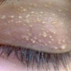 She's Got Strange White Bumps On Her Eyelids, But Had No Idea It's A Sign Of This... White Bump On Eyelid, White Bumps On Face, Pimple On Eyelid, Pomegranate Peel Powder, Bumps Under Eyes, Face Steaming, Pimples Under The Skin, Home Remedies For Skin, Skin Bumps