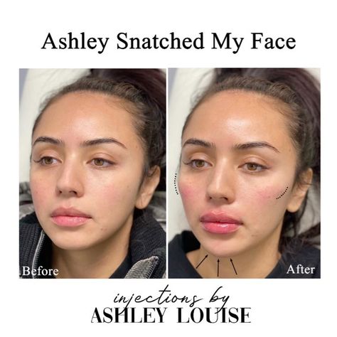 LIP QUEEN💋💉 on Instagram: “Ashley snatched my face is a package for a full face transformation! ✨ Filler was placed strategically in her cheeks, chin and lips to…” Round Face Fillers, Cheek And Chin Filler, Chin Fillers Before After Round Face, Cheek Fillers Before And After Face, Facial Balancing Filler, January Schedule, Filler Transformation, Snatched Face, Facial Balancing