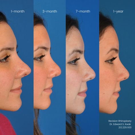 Many patients' main concern after surgery is swelling. Here, you can see our lovely patient's progress through her healing journey after revision rhinoplasty. Swelling decreases significantly between every follow-up appointment. Contact us today! #drkwak #dredwardskwak #rhinoplasty #nosejob #nosejobbeforeandafter #plasticsurgery #plasticsurgeon #cosmeticsurgery #cosmeticsurgeon #bestrhinoplasty #rhinoplastyspecialist #revisionrhinoplasty Rhinoplasty Swelling Progression, Rhinoplasty Recovery Timeline, Revision Rhinoplasty, Kpop Plastic Surgery, Jaw Reduction Surgery, Rhinoplasty Recovery, Face Plastic Surgery, V Line Surgery, Plastic Surgery Fail