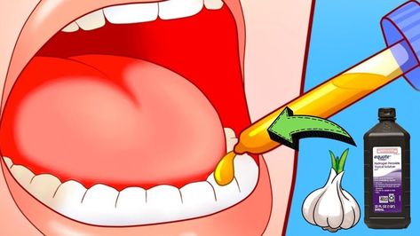 5 Ways To Relieve A Toothache In 1 Minute Infected Toothache Remedies, Inflamed Gums Remedies, Tooth Ache Relief Remedies Diy, Toothache Remedies Instant, Tooth Pain Remedies, Abscess Tooth, Severe Tooth Pain, Tooth Pain Relief, Remedies For Dry Mouth