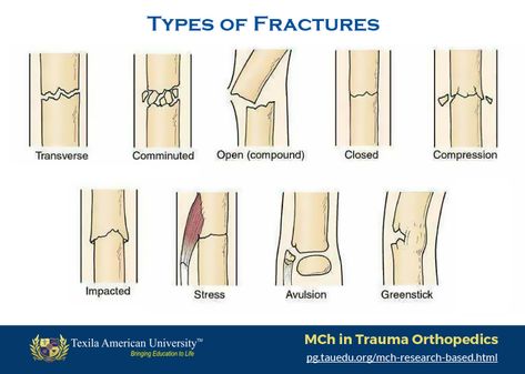 Types Of Fractures, Medical Terminology Study, Radiology Student, Radiology Technician, Bone Fracture, Nursing Student Tips, Medical Student Study, Nursing School Survival, Medical School Studying