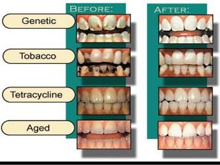 Tooth Bleaching, Tooth Nerve, Dental Bleaching, Peroxide Uses, Implant Dentist, Tooth Whitening, Discolored Teeth, Laser Teeth Whitening, Teeth Bleaching