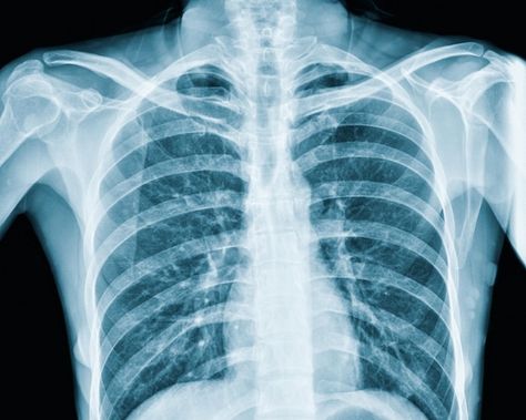 Photo xray of the lungs of an asian woma... | Premium Photo #Freepik #photo #xray #radiography #pulmonary #lung-disease Lung Xray, Rad Tech Aesthetic, X Ray Vision, Xray Machine, Human Rib Cage, Medical Diagnosis, X-ray Images, Tech Aesthetic, Rad Tech