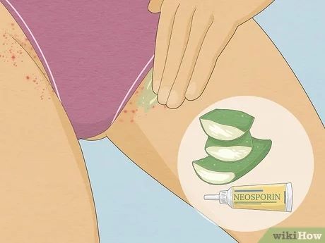 How To Get Rid Of Hair Bumps Down There, Best Home Remedy For Razor Bumps, How To Get Rid Of Inner Thigh Bumps, Natural Remedies For Razor Bumps, Get Rid Of Shaving Bumps Bikinis, How To Get Rid Of Bumps On Private Area, How To Not Have Razor Bumps Down There, What Helps With Razor Bumps, Why Do I Get Razor Bumps