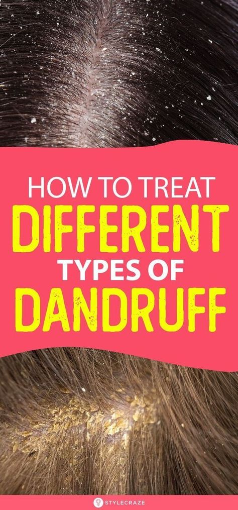 HOW TO TREAT DIFFERENT TYPES OF DANDRUFF AT HOME Bad Dandruff, Severe Dandruff, Dandruff Causes, How To Treat Dandruff, Dandruff Solutions, Home Remedies For Dandruff, Dandruff Flakes, Dandruff Remedy, Getting Rid Of Dandruff