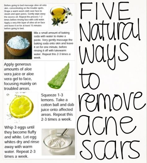 Acne Scar Removal Check more at http://www.healthyandsmooth.com/skin-care/acne/acne-scar-removal/ Ways To Remove Acne, Acne Scar Removal, Scar Removal, Cystic Acne, Acne Remedies, Natural Therapy, Skin Remedies, How To Get Rid Of Acne, Remove Acne