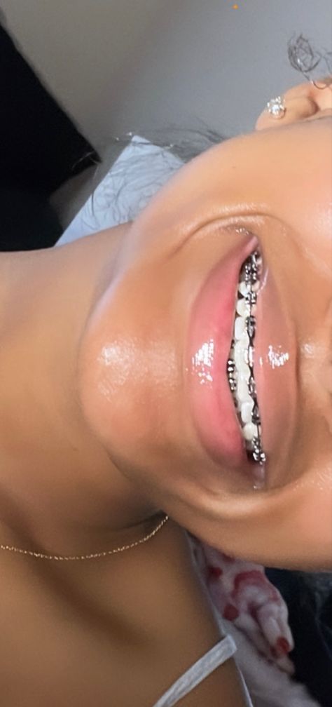 Pretty Teeth With Braces, Briblixks Pics, Braces And Lipgloss, Braces Colors Light Skin, Braces For Black Women, Braces Aesthetic Girl Black, Pink Braces Black Women, Braces Colour Ideas, Braces Colors Black Women