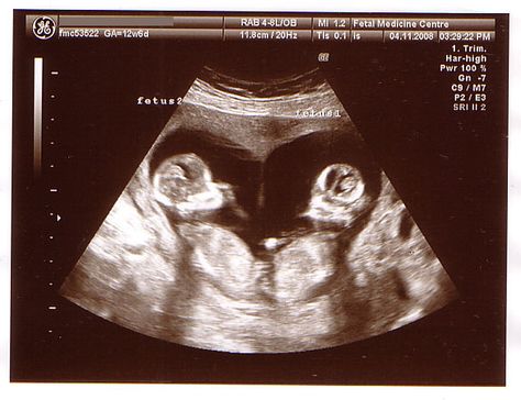 twin fetus at 20 weeks | twin b head twin a head twin b hand twin a hand Twins Ultrasound, 12 Week Scan, Baby Ultrasound Pictures, Twin Baby Boys, Baby Ultrasound, Baby Scan, Ultrasound Pictures, Twin Pregnancy