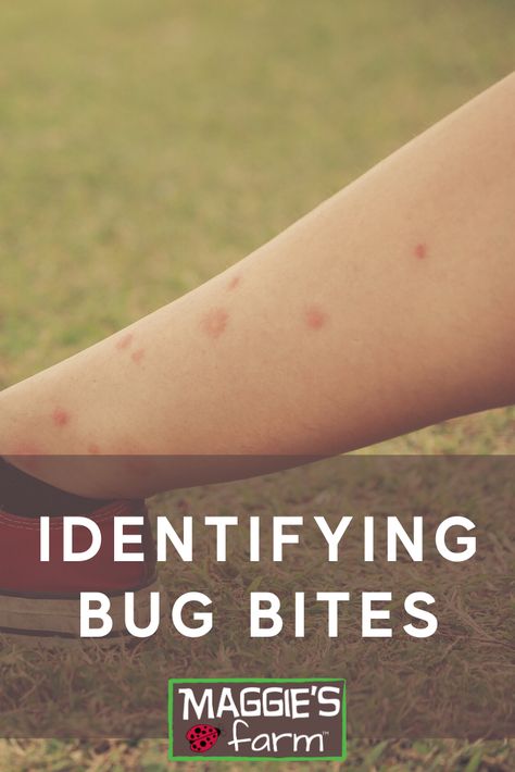 Someone sitting on the grass with a close up of their leg with multiple red bug bites How To Get Rid Of Bug Bites Fast, Insect Bite Identification Chart, Bug Bites Identifying Chart, Bug Bites Identifying, Bed Bug Bites Pictures, Types Of Bug Bites, Spider Bites Pictures, Wasp Sting Remedy, Gnat Bites