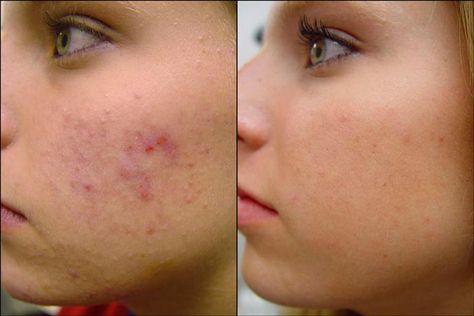 Cheek Acne, Acne Facial, Scar Removal, Cystic Acne, Prevent Acne, Acne Remedies, Anti Acne, How To Get Rid Of Acne, Acne Skin