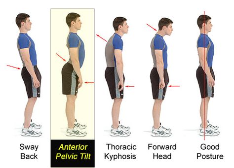 How to retain a proper posture when sitting, standing, walking? - Physical Fitness Stack Exchange How To Get Tall, Anterior Pelvic Tilt, Grow Taller Exercises, Posture Correction Exercises, Taller Exercises, Posture Fix, Posture Collar, Pelvic Tilt, Posture Exercises