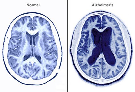 Diseases Pictures, Alzheimers Caregivers, Caregiver Burnout, Alzheimer Care, Brain Scan, Brain Tissue, Alzheimers Awareness, Disease Symptoms, Healing Touch