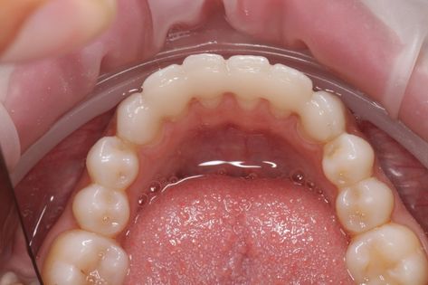 Permanent Retainer, Dental Design, Front Teeth, Sodium Bicarbonate, An Aesthetic, Keep It Cleaner, Image Search, Repair, Benefits