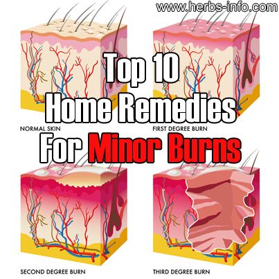 Herbs Health & Happiness Top 10 Home Remedies For Minor Burns - Herbs Health & Happiness Home Remedies For Burns, Burn Remedy, Degree Burns, Top 10 Home Remedies, Home Health Remedies, Diy Remedies, Diy Health, Natural Health Remedies, Healing Herbs