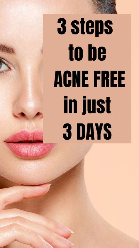 steps to be acne free in just 3 days How To Get Clear Acne Free Skin, Best Facial For Acne, How To Keep Your Face Acne Free, How To Clear Acne In A Week, Clean Face Tips Clear Skin, How To Get Rid Of Acne In A Day, How To Get Ride Of Acne In A Day, How To Clean Acne, How To Clear Face Acne