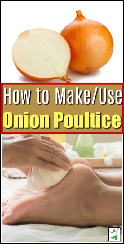 How to Make + Use an Onion Poultice for Congestion - Healthy Home Onion Poultice, Relieve Congestion, Coldsore Remedies Quick, Losing 40 Pounds, Home Remedy For Cough, Cold Sores Remedies, Skin Natural Remedies, Natural Sleep Remedies, Natural Cold Remedies