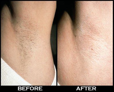 Before And After Hair, Healthy Book, Pizza Chef, Homemade Facial Mask, Armpit Fat, At Home Hair Removal, Unwanted Facial Hair, Women's Fitness Motivation, Body Hair Removal