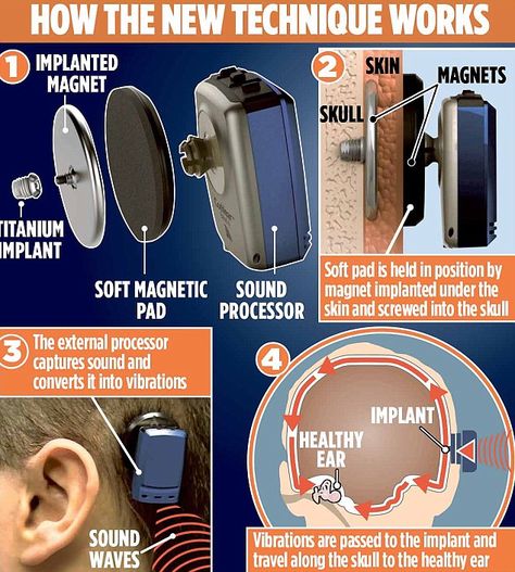 A hearing aid connected to the skull that transmits sounds via vibrations through the bones could be a solution for the one person in ten who suffers single-sided deafness (SSD). Baha Hearing Aid, Aural Rehabilitation, Ear Sound, Cochlear Implant, Hearing Health, Medical Anatomy, Hearing Loss, Learning Disabilities, The Skull