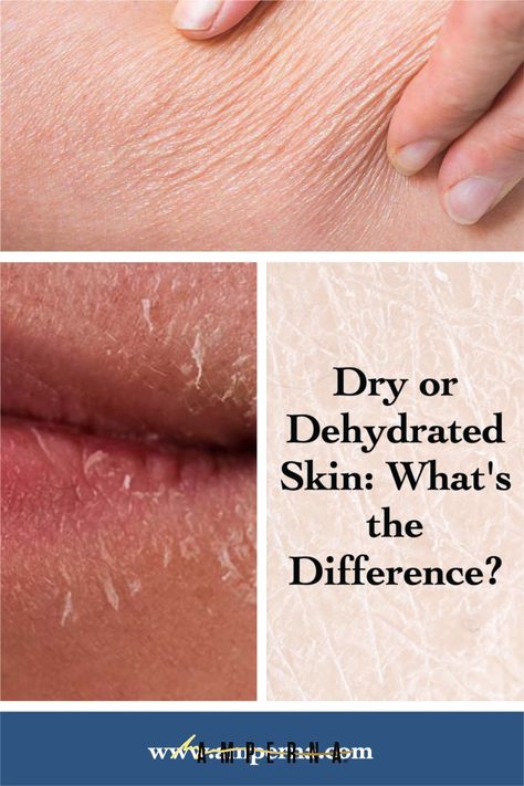 How To Hydrate Face Dry Skin, How To Fix Dehydrated Skin, Dehydrated Skin Face, Dry Vs Dehydrated Skin, Super Dry Skin Remedies, How To Hydrate Skin, Dehydrated Skin Care Routine, Dehydrated Face, Dry Peeling Skin