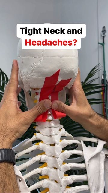 Dr. Joe Damiani - TMJ, Head & Neck Specialist on Instagram: "Do you experience persistent headaches and you also feel tension in the back of the neck and base of the skull? Well, you may be experiencing tightness from the neck which is compressing the nerves at the base of the skull producing suboccipital neuralgia, which is compression of the greater occipital nerve. These types of headaches can be persistent in the back of the head or the side of the head all the way to the eye. This is a great way to release those muscles and free up the space in the base of the skull to reduce headaches. #tensionheadache #headacherelief #migrainelife #cervicogenicheadache #tmjtreatment #tmjdisorder" Neck Headache, Reduce Headaches, Spine Problems, Occipital Neuralgia, Muscle Stretches, Headache Types, Neck Exercises, Back Of The Head, Tension Headache