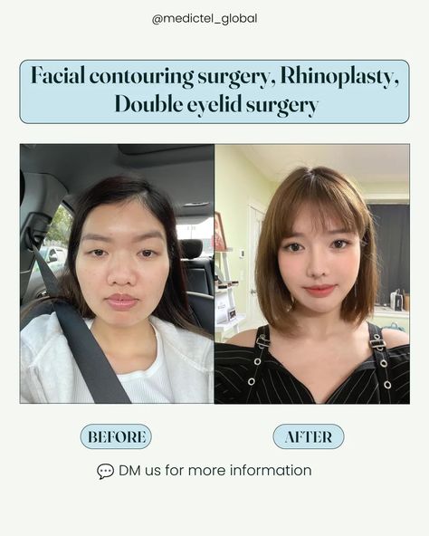 More info about her plastic surgery in Korea ⬇️ Here are the procedures that she underwent:  ✅️ Facial contouring surgery: cheekbone reduction, jaw angle reduction & genioplasty ✅️ Rhinoplasty: silicon implant, donor rib cartilage, ear cartilage & alar base reduction ✅️ Double eyelid surgery non-incision method In Korea 🇰🇷 , it's common to undergo several plastic surgery procedures at once. This method allows for one recovery period and can be more economical.💡 👉 That's where we come in... Facial Contouring Surgery, Jaw Angle, Cheekbone Reduction, Jaw Reduction Surgery, Silicone Implants, Reduction Surgery, Facial Contouring, Plastic Surgery Procedures, Double Eyelid