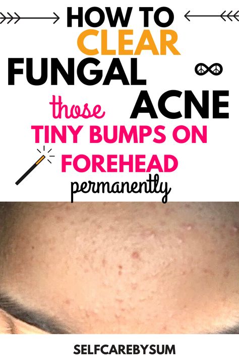 How to clear fungal acne: those tiny bumps on forehead - Self-Care by Sum #acne #pimples #pimplesremedies #acneremedies #skincarediy. https://whispers-in-the-wind.com/combatting-pimples-under-the-skin-expert-tips-and-product-recommendations/?135 Fungal Acne On Forehead, Nizoral For Fungal Acne, How To Treat Fungal Acne, Fungal Acne Skin Care Routine, Tiny Bumps On Forehead, Acne On Forehead, Treat Fungal Acne, Small Bumps On Forehead, Small Bumps On Face