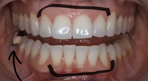 Front Teeth Veneers Before And After, Teeth Veneers Before And After, Porcelain Veneers Before And After, Composite Veneers Before And After, Veneers Before And After, Tooth Veneers, Veneers Teeth, Crooked Teeth, Loose Tooth