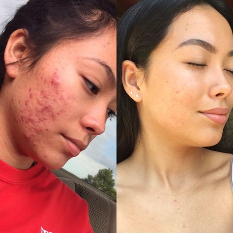 My before and after acne transformation ✨ I quit dairy 6 months ago and haven’t looked back! I have a new video on my YouTube channel talking more about it please check it out ❤️ https://youtu.be/CsubDPZwvvU Acne Before After, Skincare Before And After, Acne Transformation, Dark Joke, Girl With Acne, Before And After Acne, Acne Positivity, Lice Shampoo, Bad Acne