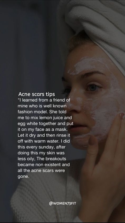 Acne scars tips 💫 How To Fix Acne Scarring, Diy Acne Scar Remover, Face Acne Remedies, Acne Natural Remedies, How To Remove Scars, Wholesome Lifestyle, Acne Reasons, Acne Scar Removal Cream, Acne Scar Remedies