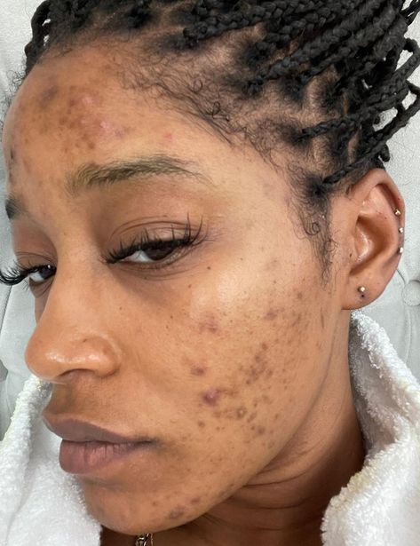 Girl With Acne, Forehead Acne, Bad Acne, Natural Acne Remedies, Pacific Islander, Acne Causes, Best Serum, Keke Palmer, Brighten Skin Tone