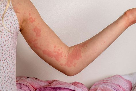 Autoimmune hives can appear when the body’s natural defense system attacks normal cells and tissues. Here’s what to know about autoimmune urticaria. How To Treat Hives, Allergy Hives, Fever Rash, Chronic Hives, Natural Medicines, Road Rash, Common Medications, Scaly Skin, Medical Terminology