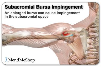 Subacromial Bursitis, Shoulder Bursitis, Bursitis Shoulder, Shoulder Rehab Exercises, Shoulder Pain Exercises, Neck And Shoulder Exercises, Shoulder Rehab, Shoulder Problem, Shoulder Impingement