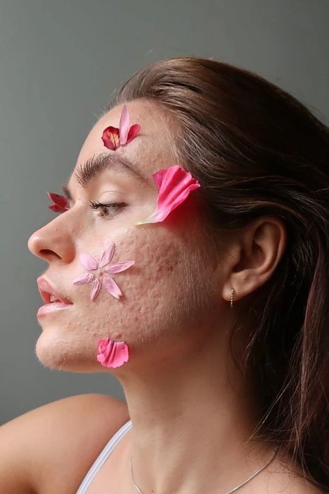 "Skin is not good or bad; it’s not a point of conversation": Decoding the skin neutrality movement | Vogue India #SkinPositivity #FreetoBeMe #Skin Acne Photography Beauty, Photography Of Insecurities, Skin Imperfections Photography, Skin Positivity Aesthetic, Bad Skin Pictures, Body Neutrality Photography, Body Positive Photography Ideas, Body Acne Positivity, Women Body Positive Photography