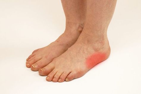 Cuboid syndrome can be one of the most misdiagnosed foot conditions - in part because many people have never even heard of it. Check out our latest blog article to learn what cuboid syndrome is, and how a chiropodist can help. #footpain #footcare #healthandwellness #torontofootclinic #feet #health #cuboidsyndrome #torontobloggers Cuboid Syndrome, Foot Pain Relief Remedies, Ankle Pain Relief, Pain Relief Remedies, Foot Exercises, Ankle Pain, Foot Pain Relief, Trigger Points, Sports Medicine