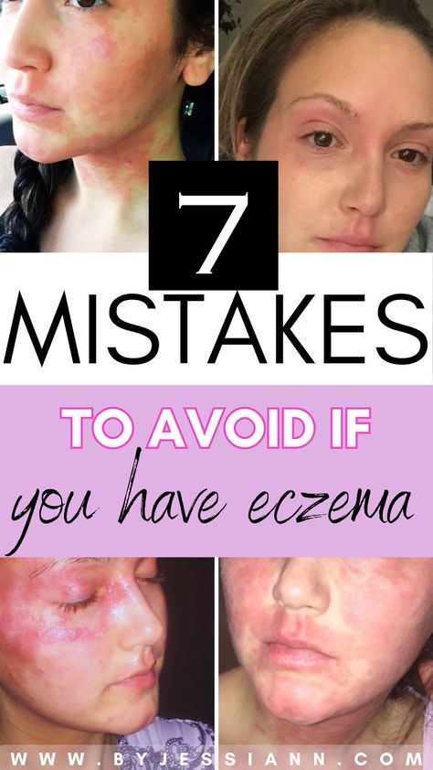 7 eczema triggers to avoid for clear skin - eczema remedies & excema relief tips Get Rid Of Excema, Excema Relief, Itchy Skin Remedy, I Healed, Severe Dry Skin, Natural Remedies For Migraines, Itching Skin, Treat Acne, Dry Skin Remedies