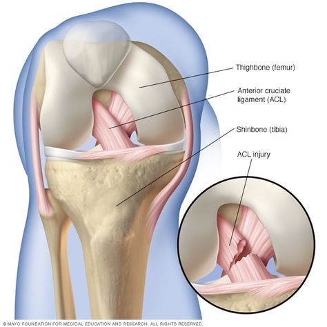 ACL injury - Symptoms and causes - Mayo Clinic Acl Recovery, Acl Injury, Acl Surgery, Anterior Cruciate Ligament, Acl Tear, Ligament Injury, Cruciate Ligament, Knee Pain Relief, Soccer Tennis