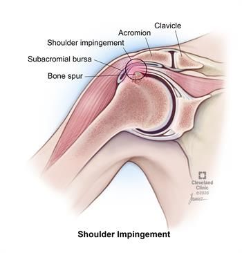 Shoulder Impingement Syndrome: Causes, Symptoms & Treatments Forward Head Posture Exercises, Rotator Cuff Tear, Shoulder Impingement, Rotator Cuff Injury, Shoulder Bones, Bicep Muscle, Forward Head Posture, Pinched Nerve, Shoulder Surgery