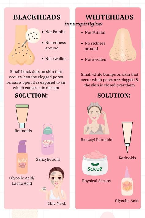 Skin Care For Whiteheads, Whiteheads Removal Remedies, Skincare For Blackheads, Skincare Blackheads, Blackheads And Whiteheads, Esthetician Marketing, Skin Advice, Aesthetic Skincare, Beauty Party