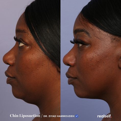 Chin lipo costs $3,000 on average, according to RealSelf members, but your price could range from under $1,000 to nearly $5,000, depending on the specifics of your surgery. Double Chin Surgery, Vaser Lipo, Lipo Before And After, Skin Tightening Procedures, Skin Tightening Treatments, Beauty Procedures, Women Health Care, Facial Plastic, Is It Worth It