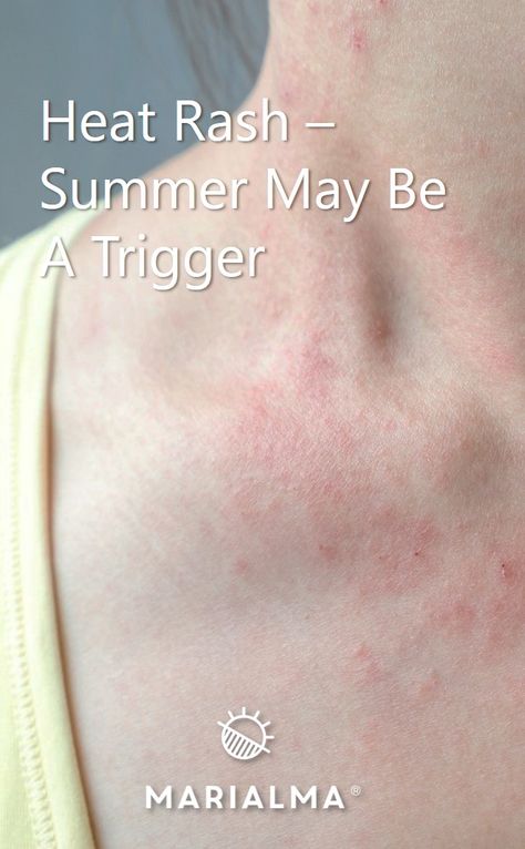 Heat Rash Remedy For Adults, Rash On Stomach, Groin Rash, Heat Bumps, Heat Rash Remedy, Prickly Heat Rash, Rashes Remedies, Prickly Heat, Itchy Rash