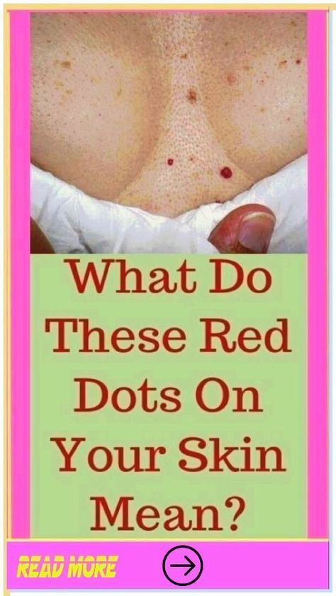 What Causes Pimples On Buttocks? 10 Effective Tips – DiyVines: Do It Yourself Bumps On Skin, Red Skin Spots, What Causes Pimples, Pimples On Buttocks, Skin Bumps, Keratosis Pilaris, Home Health Remedies, Health Trends, Learning Techniques