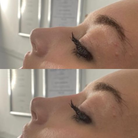 Transformation at its finest! ✨ Witness the incredible before and after results of a liquid rhinoplasty using dermal filler. Say goodbye to a bulky nose and hello to a smaller and straighter profile. 🙌✨ #RhinoplastyMagic #BeforeAndAfter #ConfidenceBoost #nosejob #nosejobuk #nosejobessex #nosejobbenfleet #rhinoplasty #rhinoplastyuk #rhinoplastyessex #rhinoplastybenfleet #liquidrhinoplasty #liquidrhinoplastyuk #liquidrhinoplastyessex #liquidrhinoplastybenfleet #nonsurgicalnosejob #nonsurgical... Liquid Rhinoplasty Before And After, Nose Filler Before After, Liquid Rhinoplasty, Nose Filler, Nonsurgical Nose Job, Nose Fillers, Rhinoplasty Before And After, Nose Job, Dermal Fillers