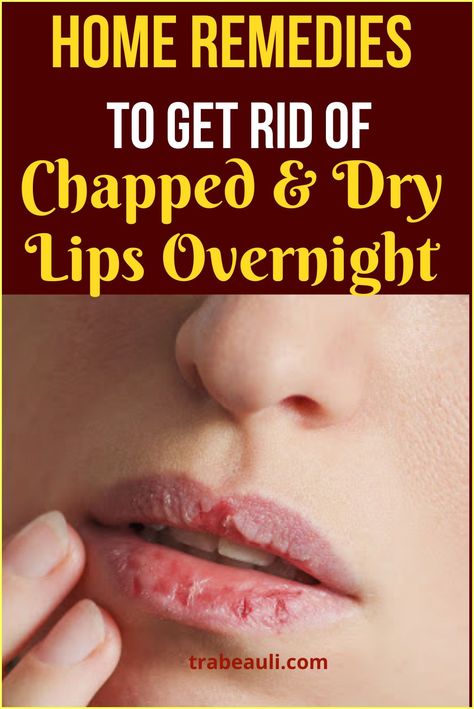 Remedies For Chapped Lips, Dry Lips Remedy, Chapped Lips Remedy, Overnight Remedies, Dehydrated Lips, Simple Graphic Design, Natural Remedies For Migraines, Winter Lips, Homemade Facial Mask