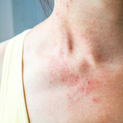 skin rash on chest Skin Rashes Pictures, Common Skin Rashes, Makeup Tips For Blue Eyes, Rashes Remedies, Itchy Rash, Skin Rashes, Home Remedies For Skin, Bug Bites, Skin Discoloration