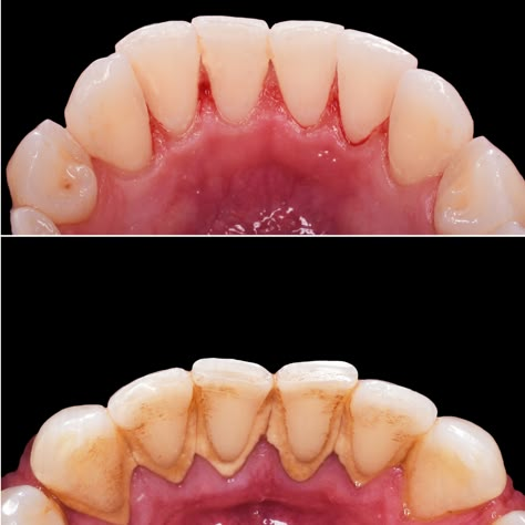 This scaling and root planning transformation is so satisfying! . . . . . . #FourCornersDentalCare #WoburnDentist #Dentist #CosmeticDentist #Cosmeticdentistry #FamilyDentist #drmoutevelis #emergencydentist #beforeandafter Dental Scaling, Baking Drawing, Dental Wallpaper, Hair And Skin Vitamins, Dental Advertising, Dental Photos, Dental Images, Dentistry Student, Dental Anatomy