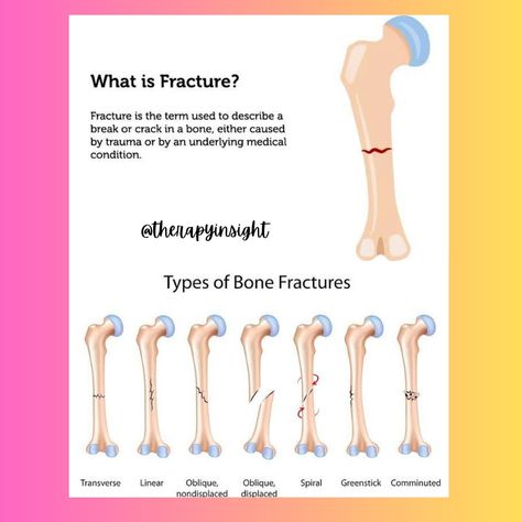 What is Fracture Types of fracture Fracture Types, Types Of Fractures, Basic Anatomy, Bone Fracture, Basic Anatomy And Physiology, Pa School, Nursing Notes, Urgent Care, Anatomy And Physiology