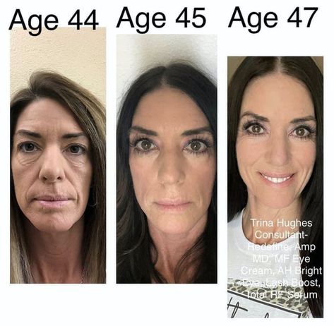 Consistency + the right products + with the right formula + in the right order = RESULTS #premiumskincare #antiagingskincare #skincarethatworks #skincarehelp Jaw Reduction Surgery, Multifunction Eye Cream, Rodan Fields Skin Care, Plastic Surgery Fail, Botox Lips, Plastic Surgery Gone Wrong, Face Surgery, Cheek Fillers, Aging Backwards