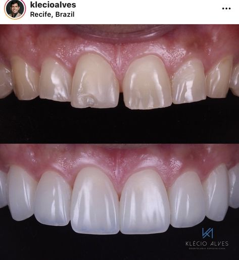 Before and after porcelain Veneers from doctor klecioalves.  The top photos is the before picture, the teeth are yellow and chipped. The Bottom photo is the after picture which is a perfect white smile. Teeth Surgery Before And After, Prosthodontics Day Posters, Best Veneers Teeth, Teeth Veneers Before And After, Dental Veneers Before And After, Dental Before And After, Porcelain Veneers Before And After, Composite Veneers Before And After, Veneers Before And After