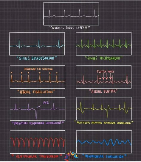 Vital Signs Chart, Graphic Score, Nurse Skills, Ekg Interpretation, Normal Sinus Rhythm, Nursing School Survival, Atrial Fibrillation, Research Images, Medical School Essentials